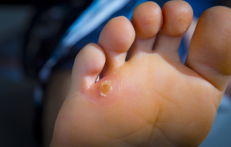 How To Treat Soft Corns On Top Of Toes